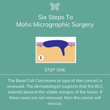 Mohs Micrographic Surgery