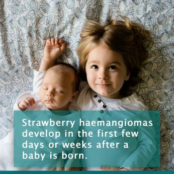 Strawberry Haemangioma