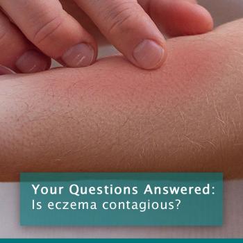 Eczema