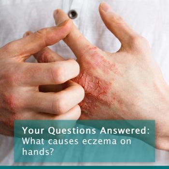 Hand Eczema