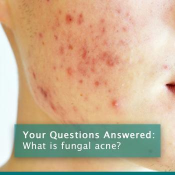 Fungal Acne Question Answered