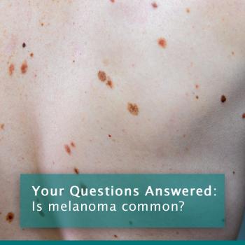 Melanomas