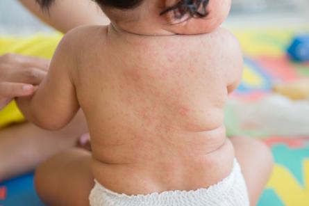 Viral Exanthem Condition, Treatments and Pictures for Infants