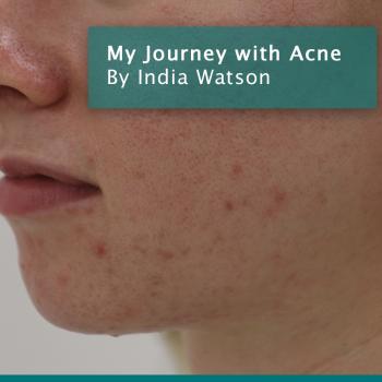 My Journey with Acne