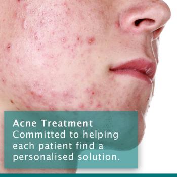 Acne Treatment