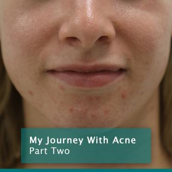 Acne Journey P2