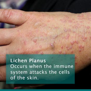 Lichen Planus Post