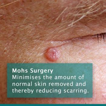 Mohs Surgery Insta