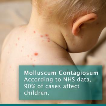 Molluscum Contagiosum