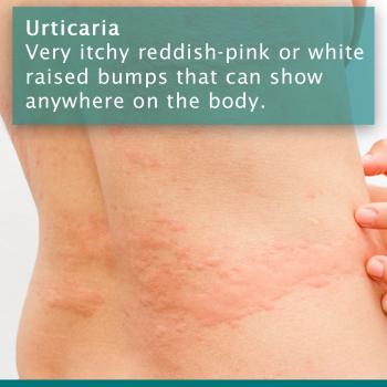 Urticaria